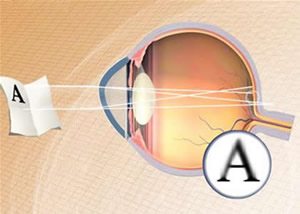 Astigmatismo